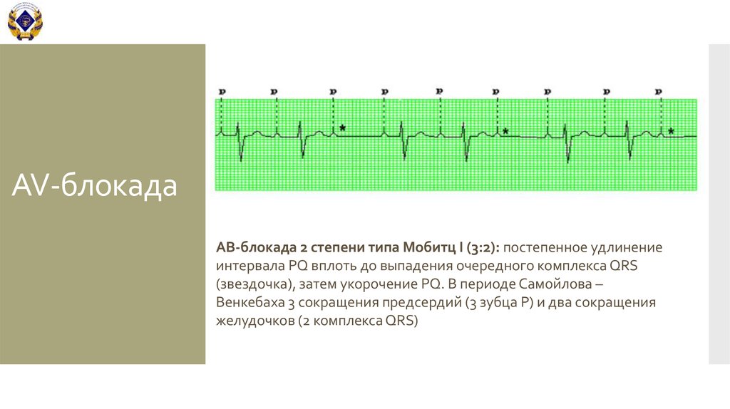 Ав блокада 2 степени