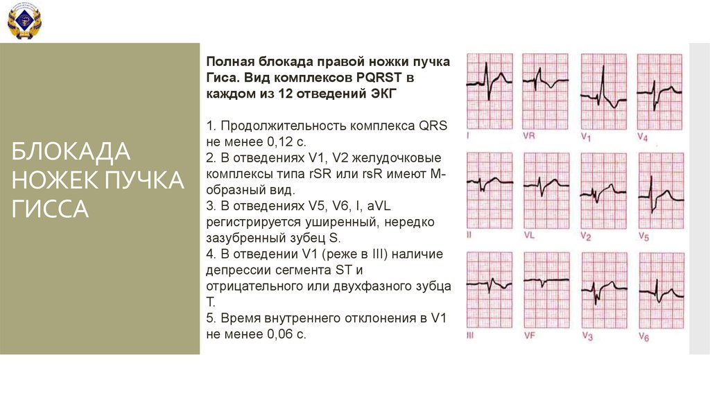 Полная блокада правой ножки пучка гиса карта вызова