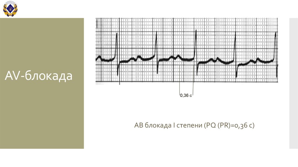 Блокада сердца степени