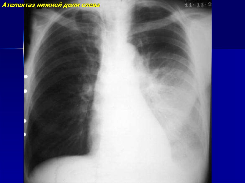 Ателектаз нижнего легкого. Рентгенограмма Тотальный ателектаз. Обтурационный ателектаз рентген. Компрессионный ателектаз легкого. Ателектаз легкого рентгенограмма.