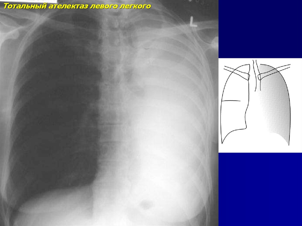 Ателектаз легкого. Ателектаз левого легкого рентген. Тотальный ателектаз легкого. Гидроторакс ателектаз. Компрессионный ателектаз рентген.