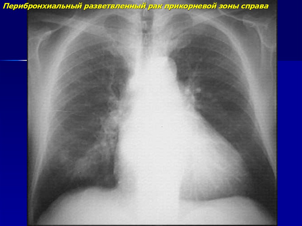 Легкие справа. Перибронхиальная пневмония. Прикорневая пневмония рентген. Перибронхиальная опухоль. Перибронхиальный разветвлённый.