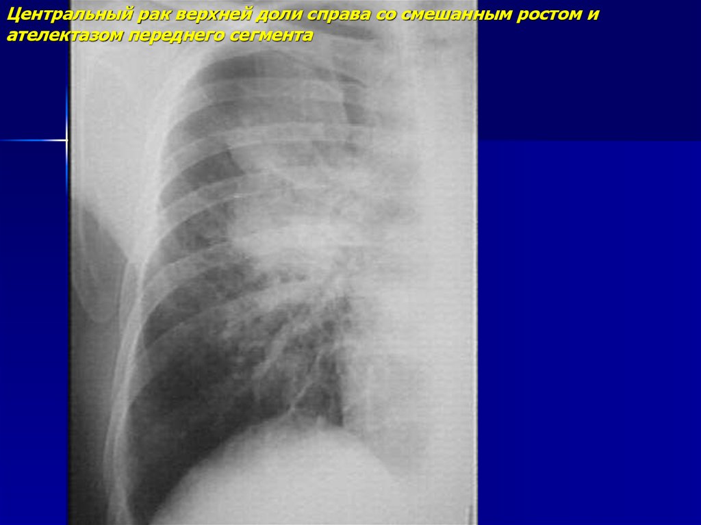 Центральный рак. Центральный верхней доли. Ателектаз верхней доли справа. Перициссурит верхней доли справа. Фои верхней доли справа.