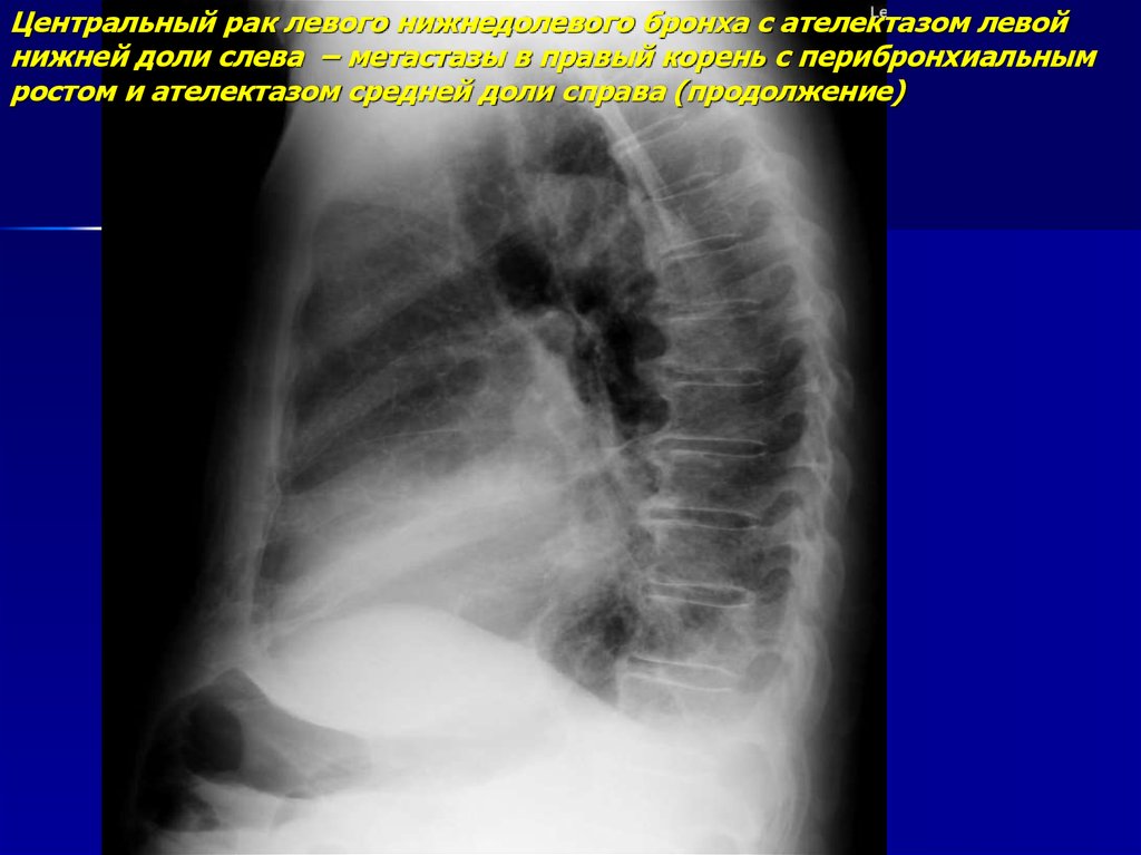 Рак центрального правого. Бронхогенная карцинома легких. Ателектаз верхней доли справа рентген. Ателектаз нижней доли справа. Ателектаз верхней доли слева рентген.