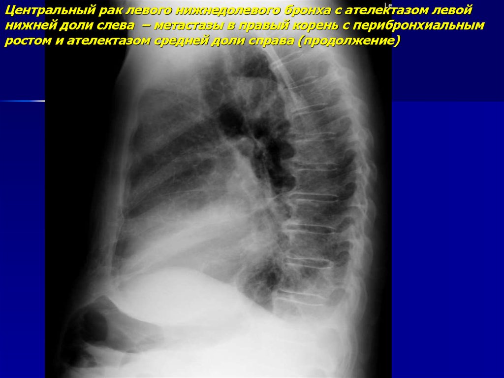 Центральный рак. Бронхогенная карцинома легких. Перибронхиальная опухоль легкого. Ателектаз нижней доли слева. Центральное образование левого легкого.