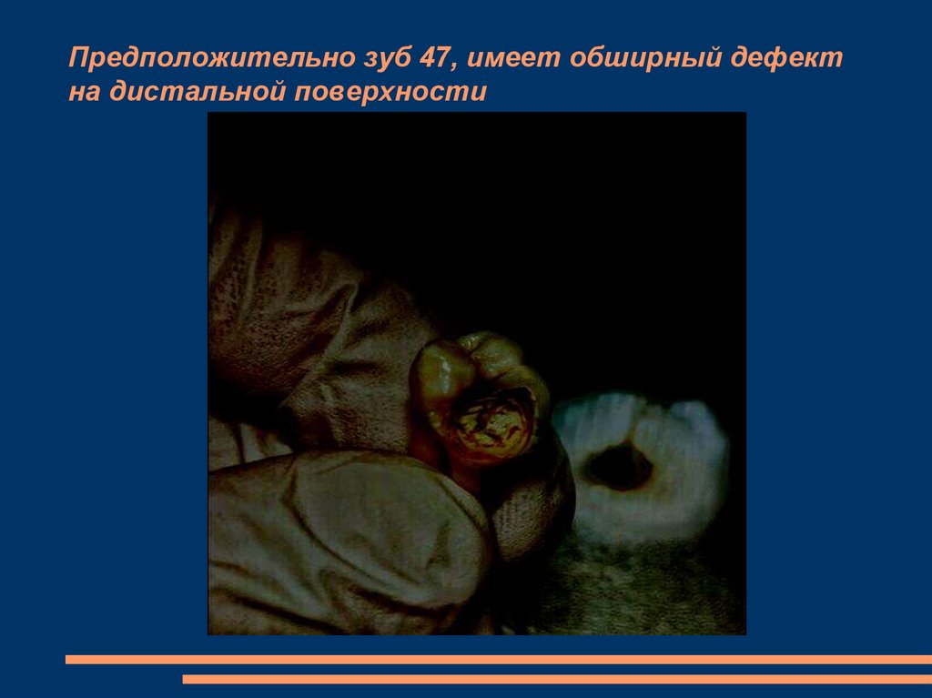 Предположительно зуб 47, имеет обширный дефект на дистальной поверхности