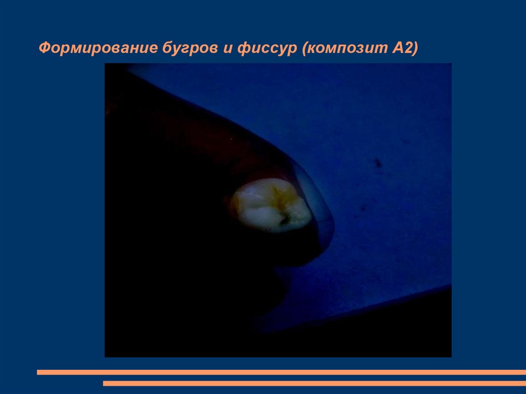 Формирование бугров и фиссур (композит А2)