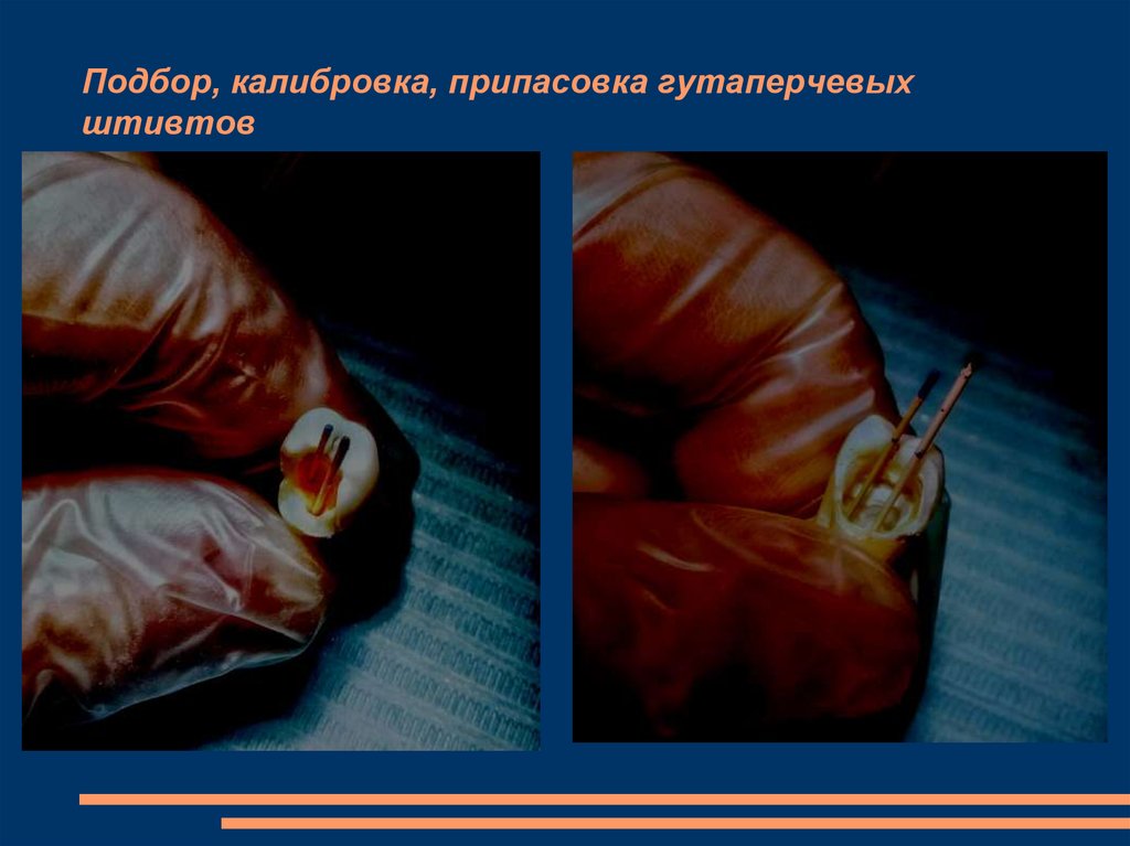 Подбор, калибровка, припасовка гутаперчевых штивтов