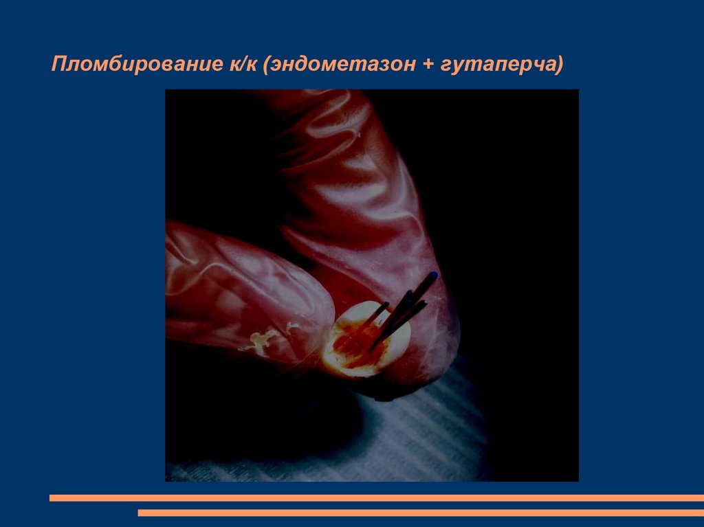 Пломбирование к/к (эндометазон + гутаперча)