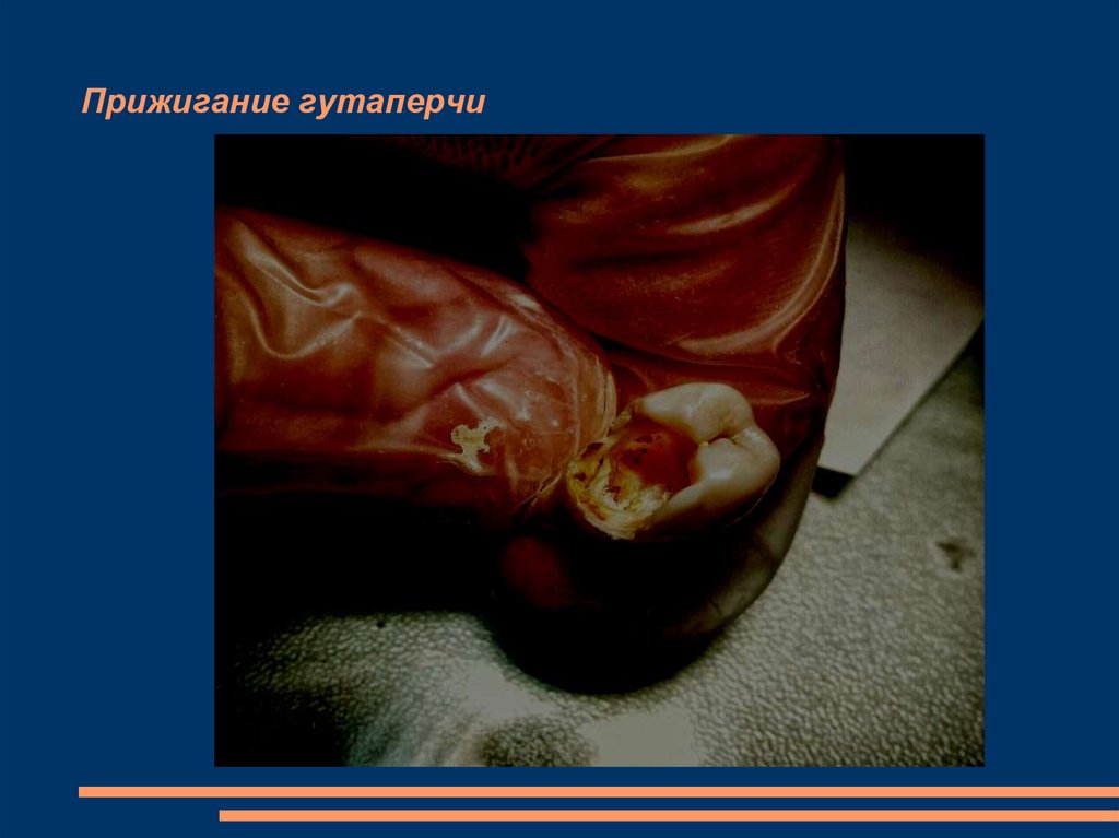 Прижигание гутаперчи