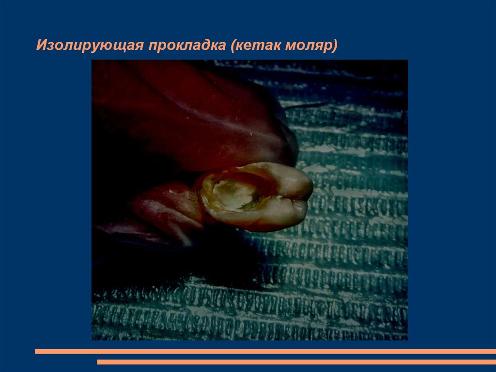 Изолирующая прокладка (кетак моляр)
