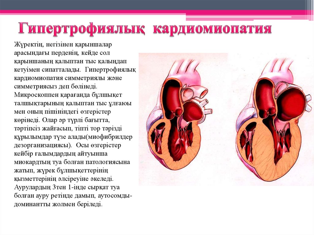 Кардиомиопатия предсердий. Дилатационная кардиомиопатия патанатомия. Гипертрофическая кардиомиопатия патанатомия. Рестриктивная кардиомиопатия это патологическая анатомия. Гипертрофическая кардиомиопатия гистология.