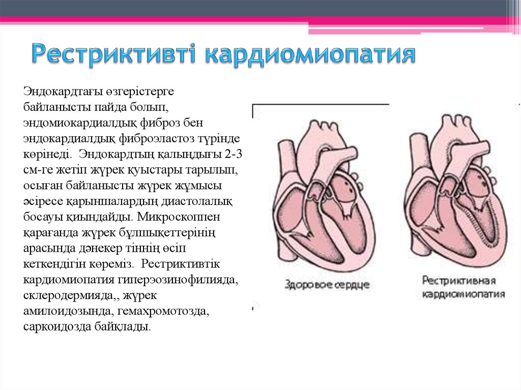 Кардиомиопатии у детей презентация