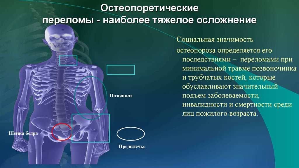 Презентация по остеопорозу