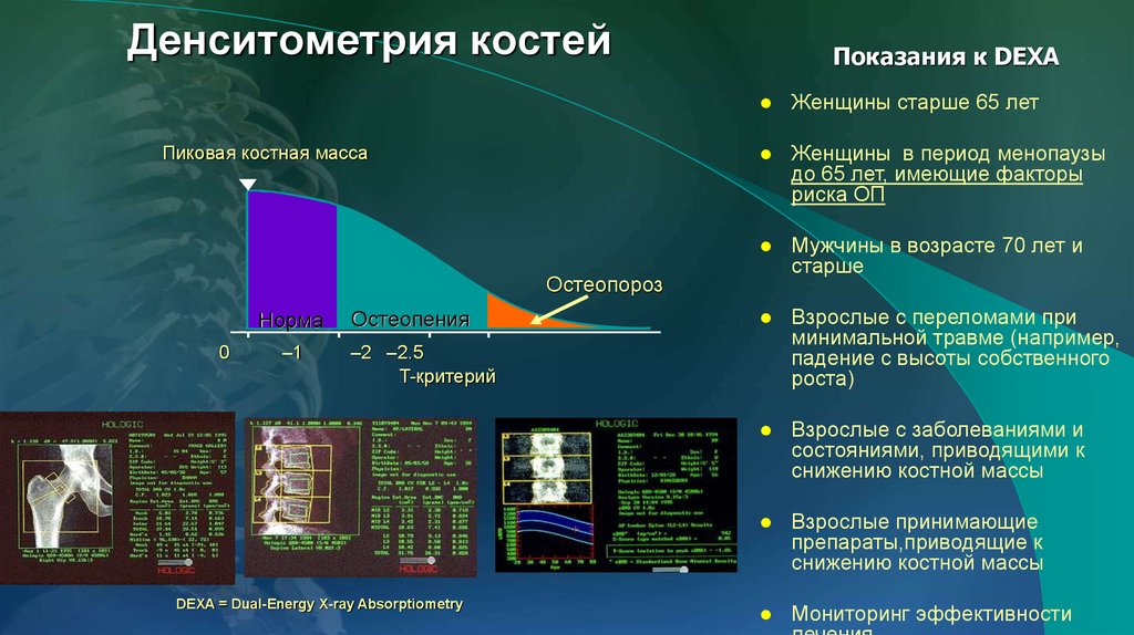 Подготовка к денситометрии. Остеоденситометрия остеопороз. Исследование плотности костей денситометрия. Остеопороз ультразвуковая денситометрия. Денситометрия костей остеопороз.