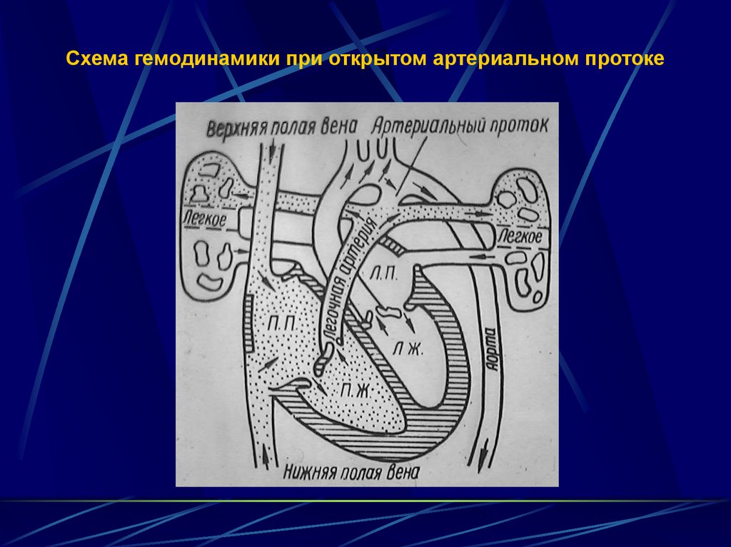 Открытый аортальный проток схема