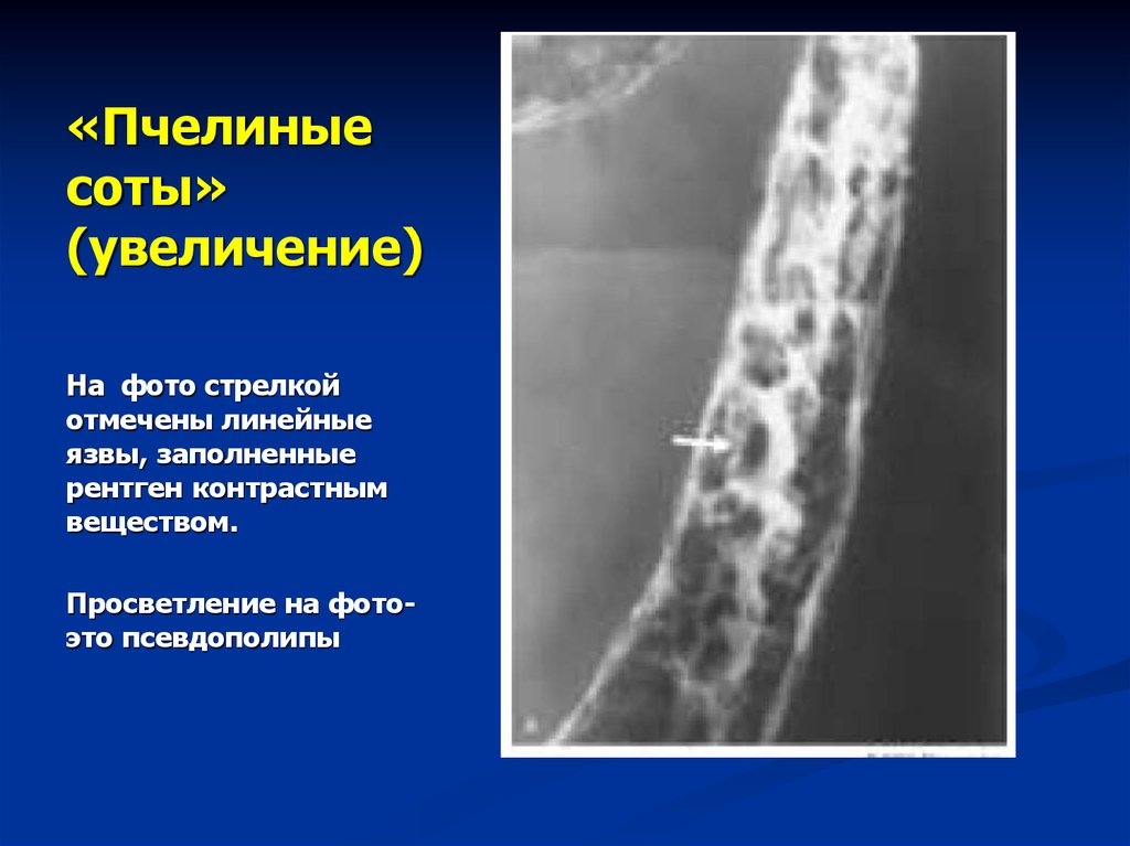 Стул при спастическом колите