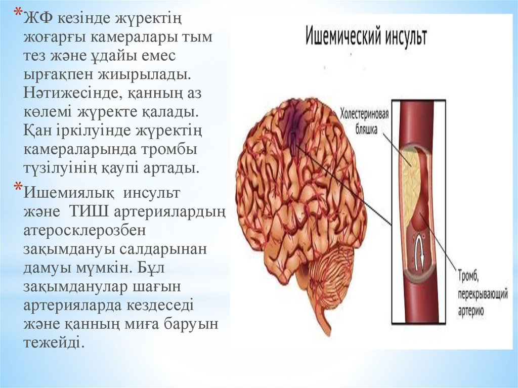 Инсульт дегеніміз не презентация