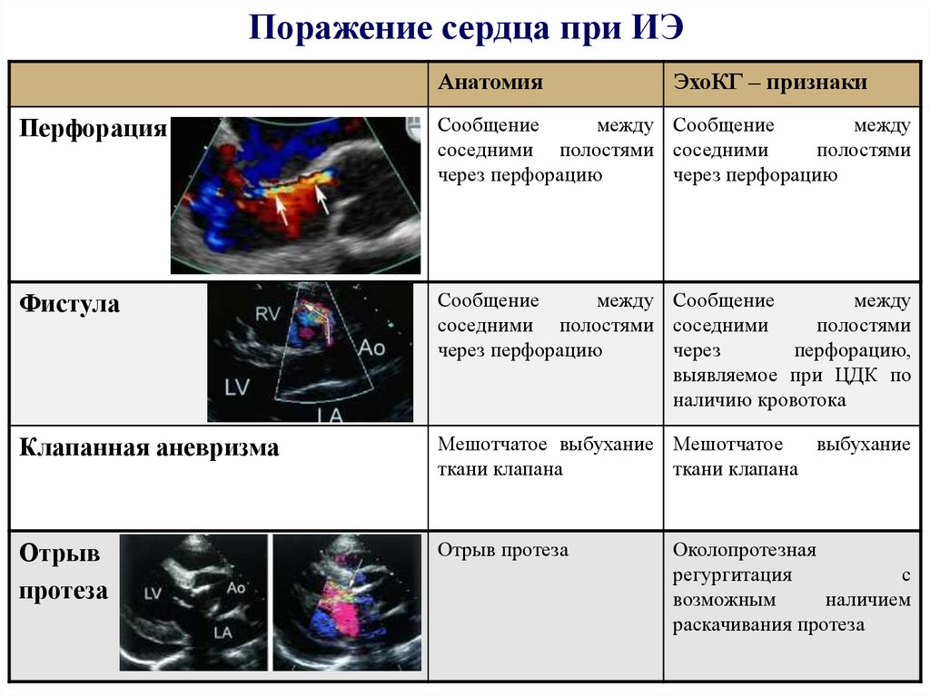 Самая частая причина смерти при инфекционном эндокардите