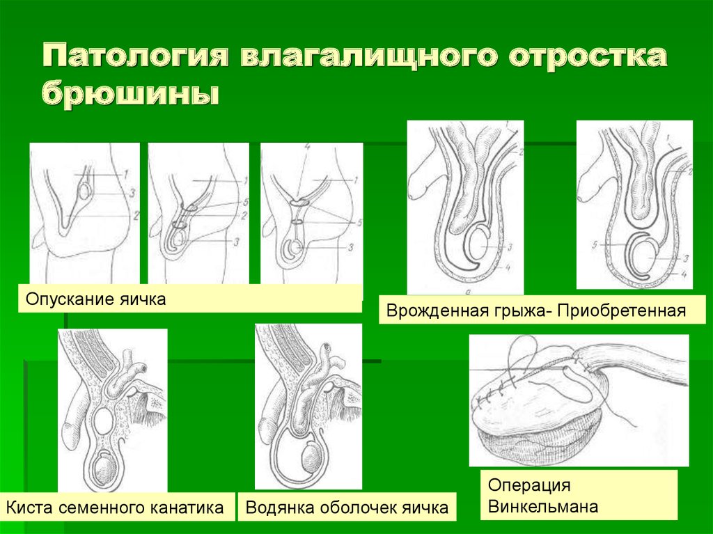 Схема опускания яичка