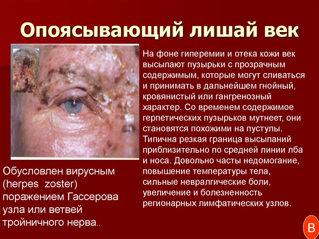 Опоясывающий лишай век