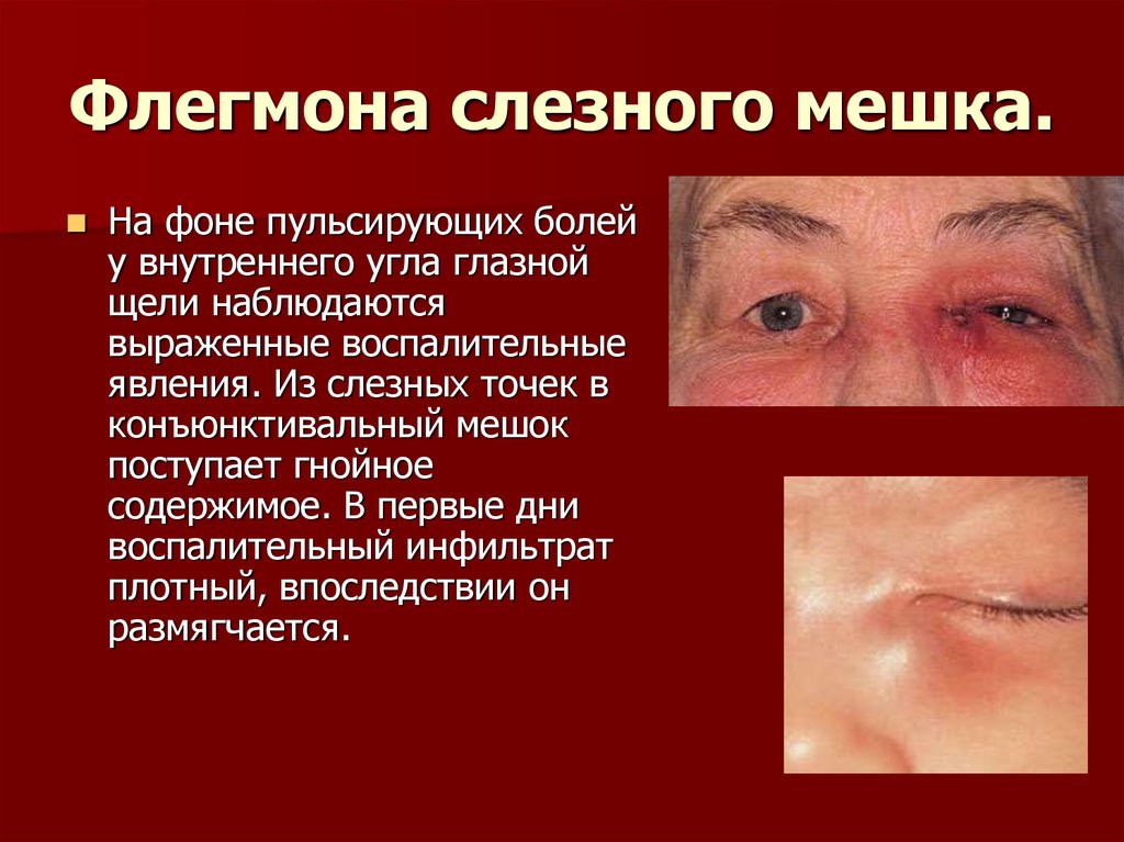 Флегмона слезного мешка.