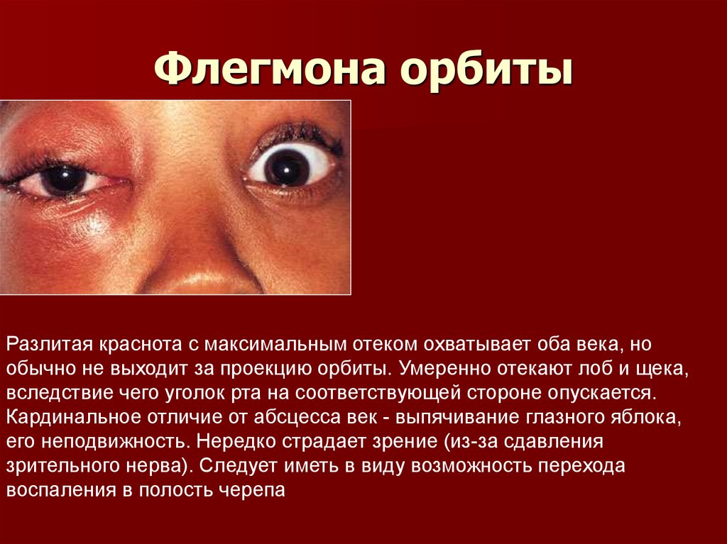 Флегмона орбиты