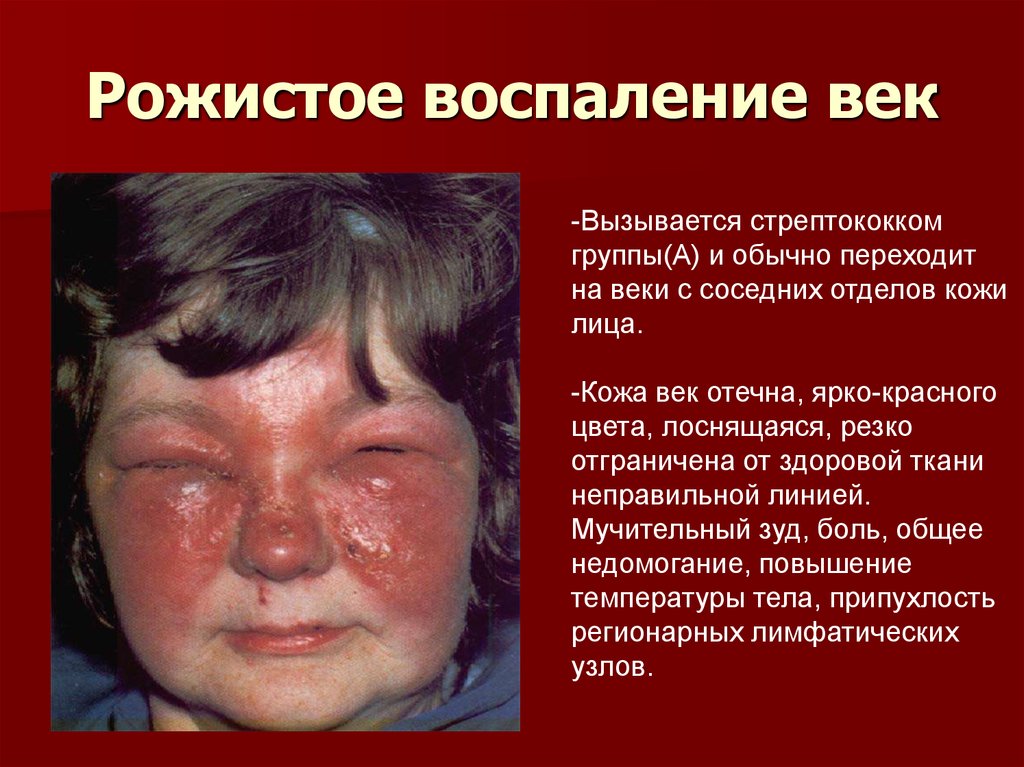 Рожистое воспаление век