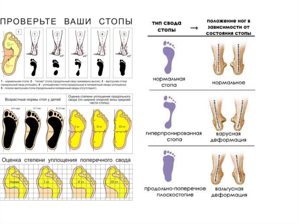 Проверить стоп. Плоско варусная постановка стопы. Плоско-вальгусная деформация стопы плоскостопие 2 степени. Плоско вальгусная деформация стопы 3 степени. Плоско варусная деформация стопы.