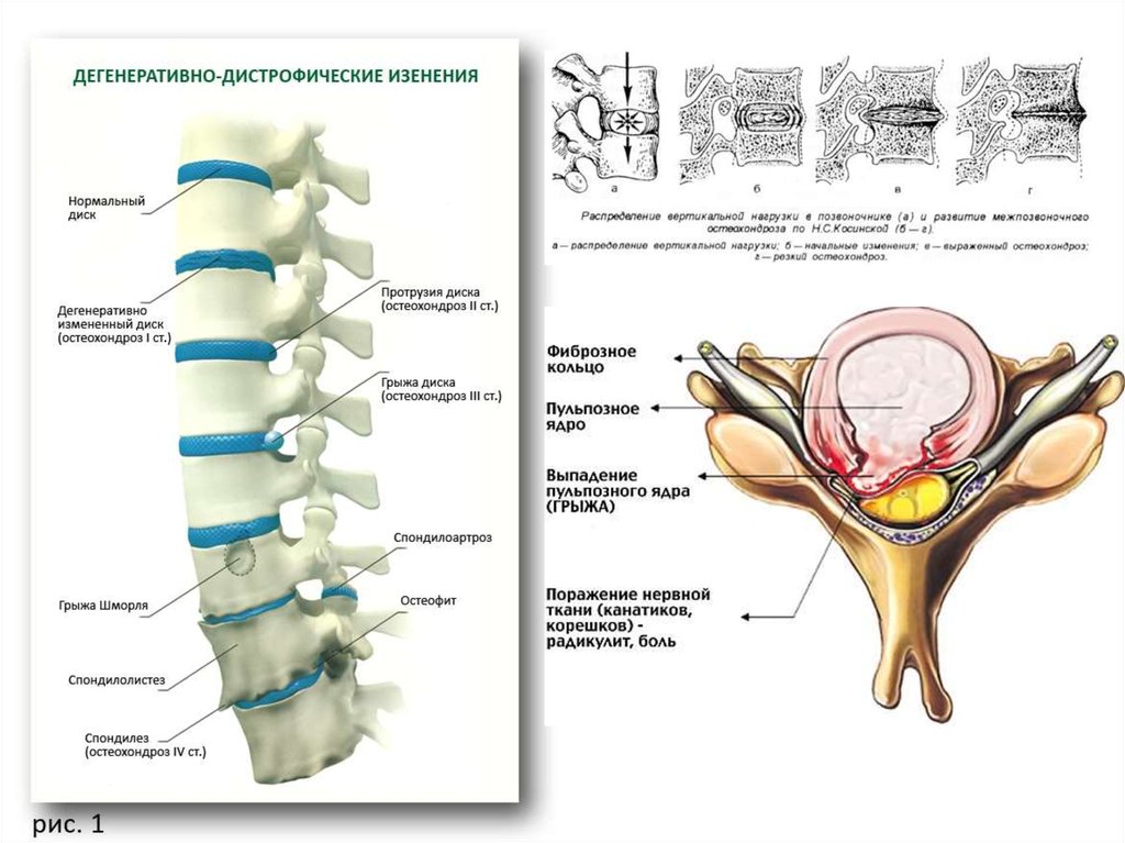 Склероз межпозвонковых дисков. Пульпозное ядро. Позвоночные диски. Ядро межпозвоночного диска. Фиброзное кольцо межпозвоночного диска.