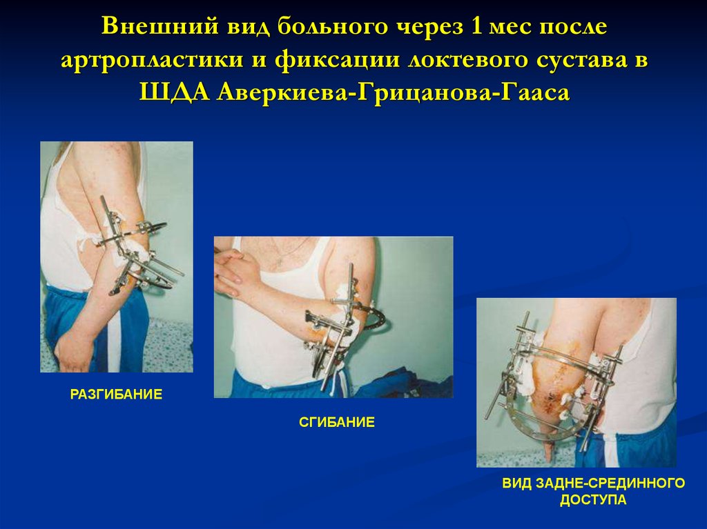 Внешний вид больного через 1 мес после артропластики и фиксации локтевого сустава в ШДА Аверкиева-Грицанова-Гааса