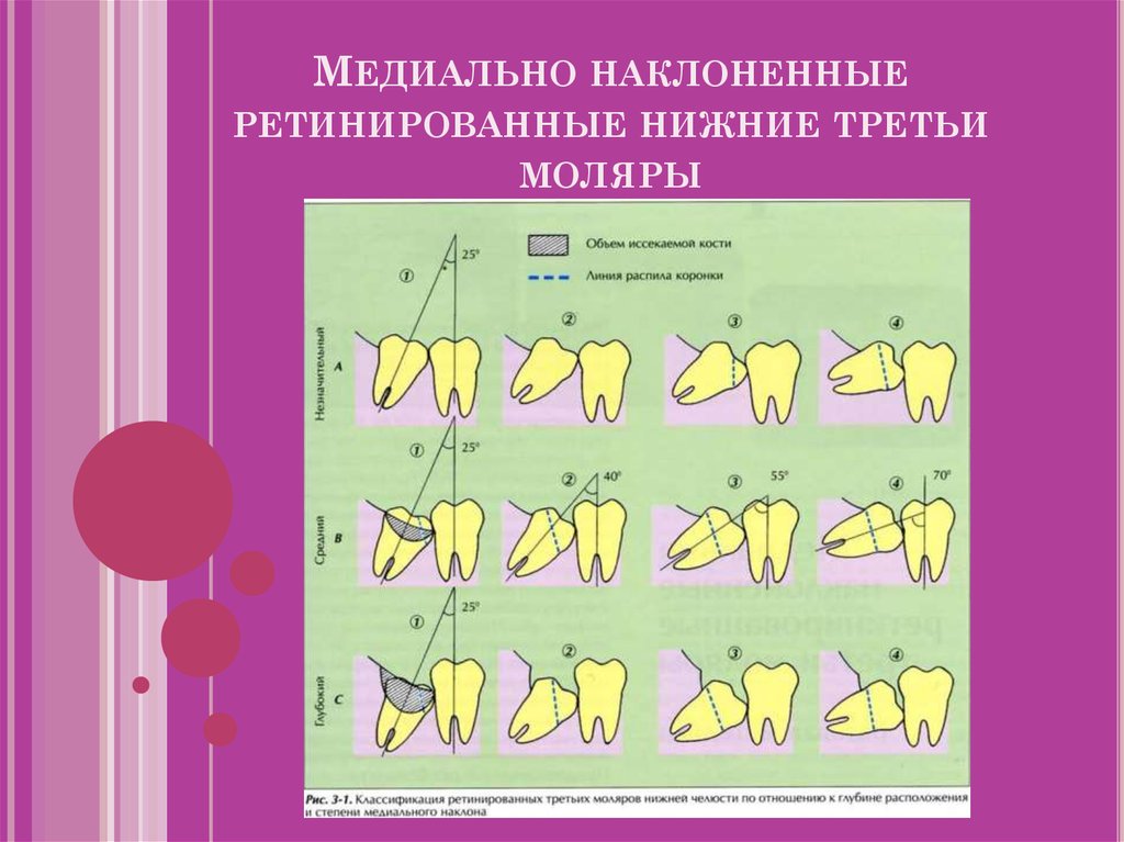 Удаление третьих моляров верхней и нижней челюсти. Ретенция и дистопия ...