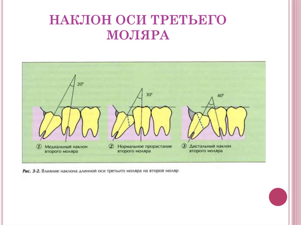 удаление третьих моляров верхней челюсти