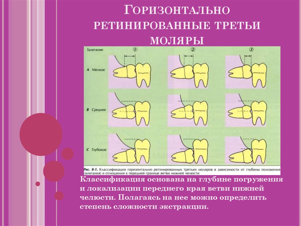 Горизонтальный тип. Классификация ретенции зубов. Классификация положения третьих моляров. Классификация дистопии и ретенции зубов. Ретенция зуба классификация.