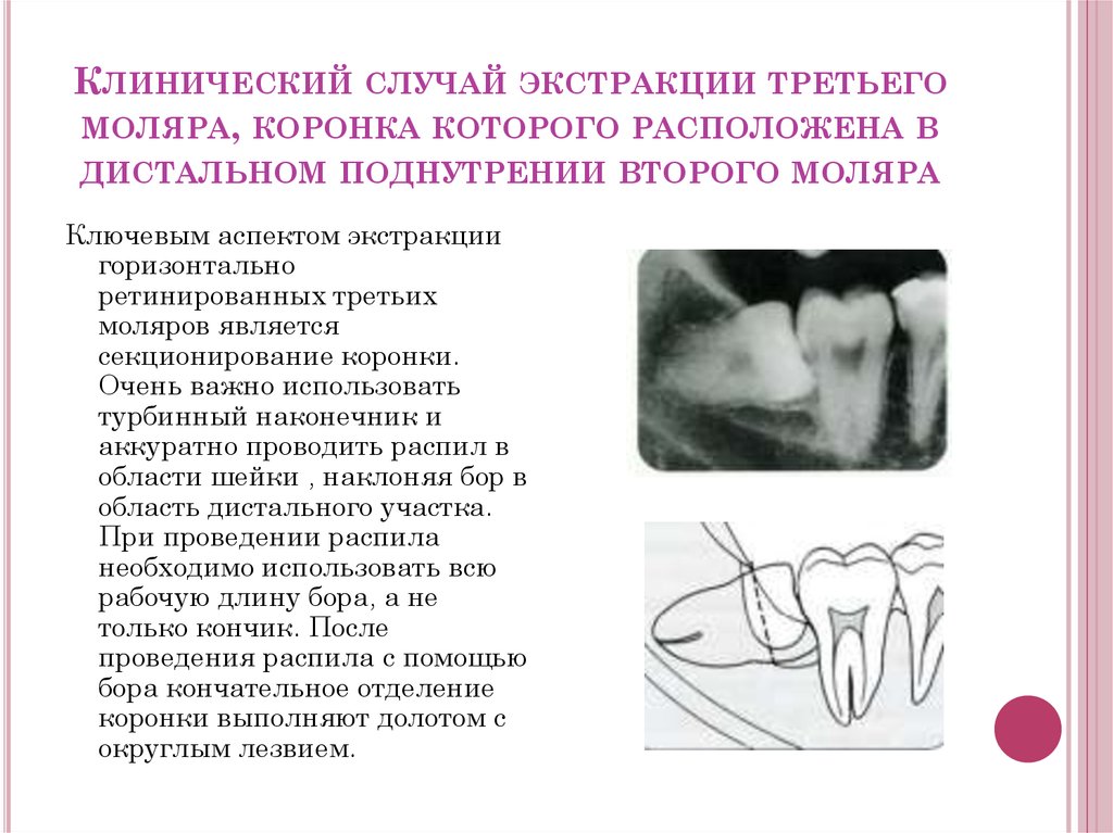 Болезни прорезывания зубов затрудненное прорезывание третьего нижнего моляра презентация