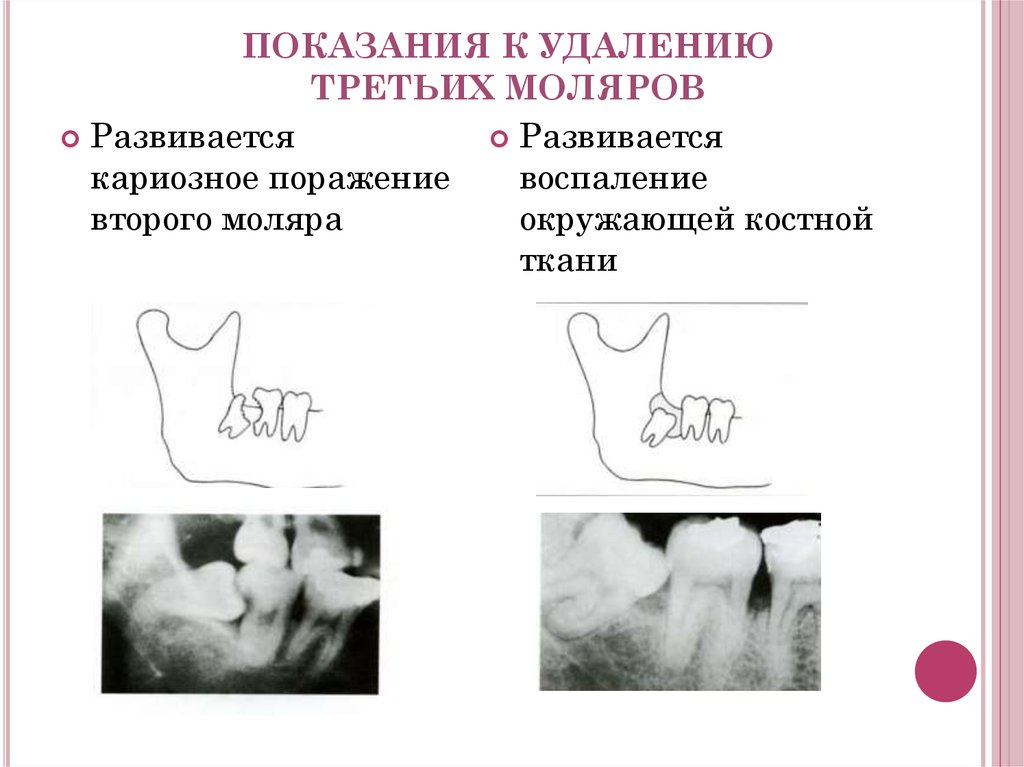 Три удаления. Ретенция зуба классификация. Показания к удалению верхнего третьего моляра. Методика удаления верхнего третьего моляра. Показания к удалению ретенированных третьих моляров.