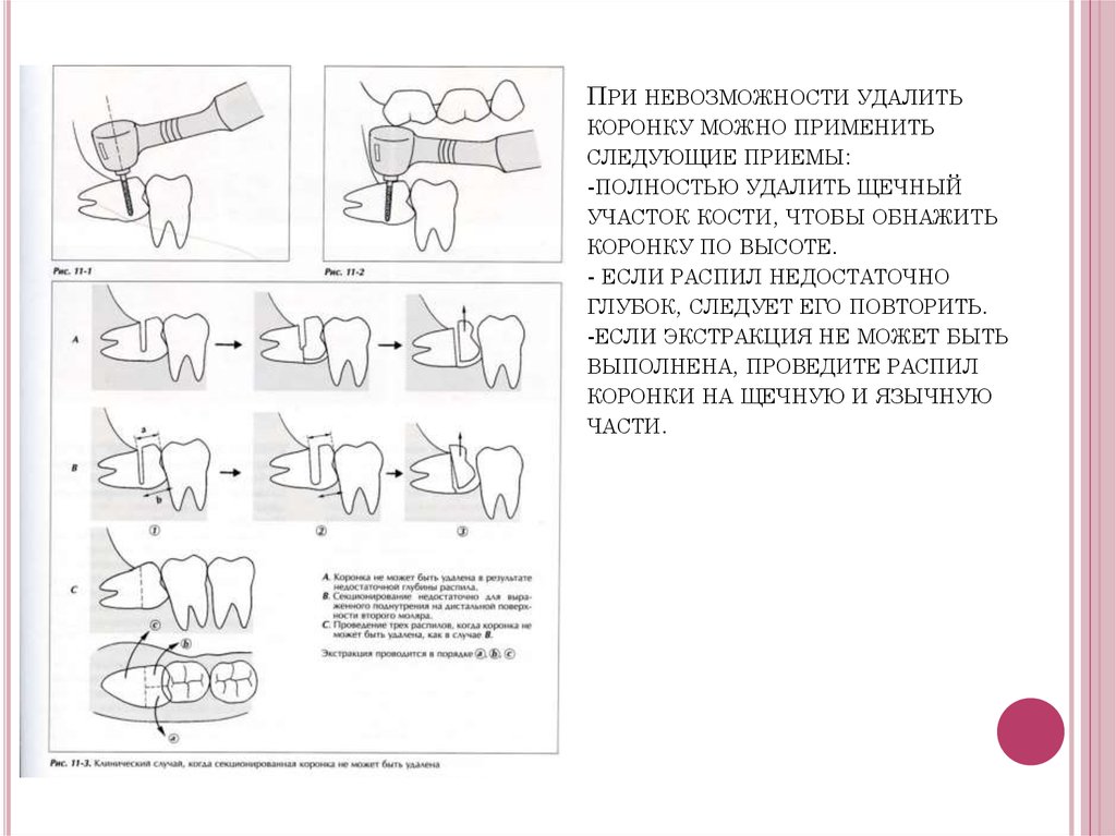При невозможности удалить коронку можно применить следующие приемы: -полностью удалить щечный участок кости, чтобы обнажить