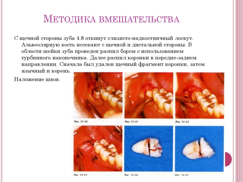 Методика вмешательства
