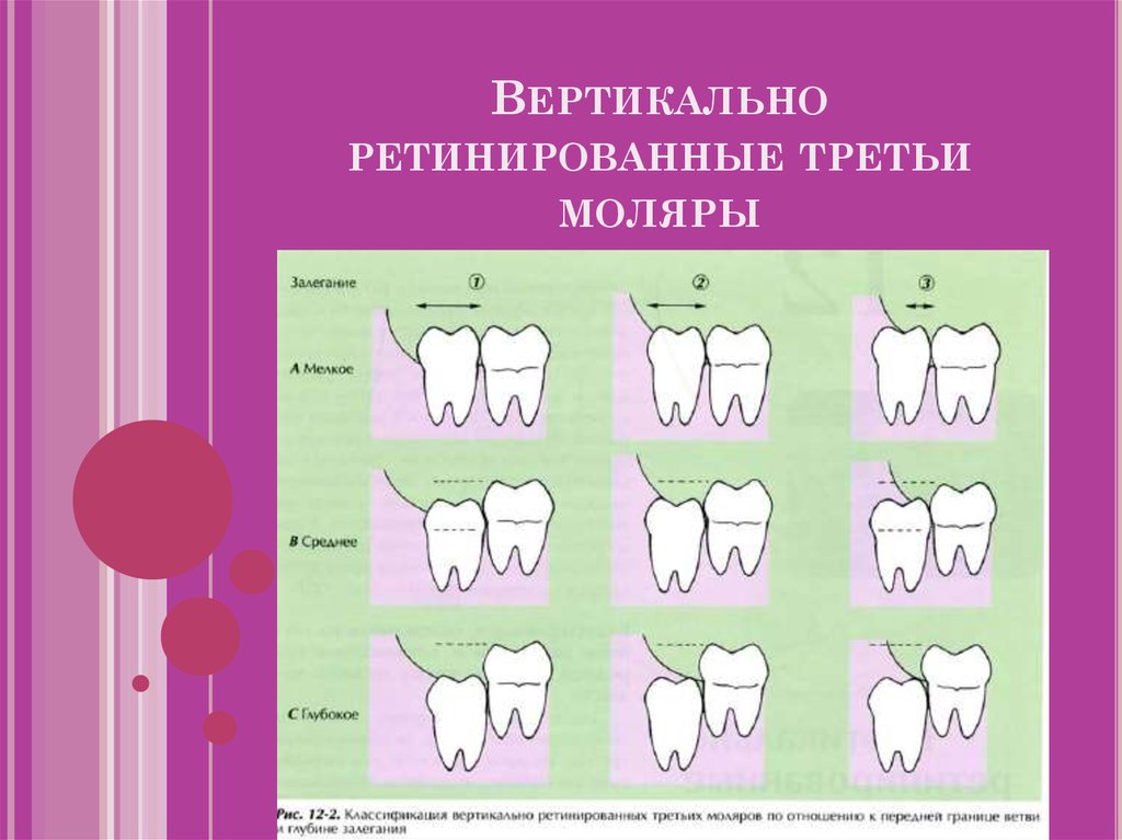 В третьих. Ретенция третьих моляров. Ретенция зуба классификация. Классификация дистопии и ретенции зубов. Ретенция и дистопия зуба.