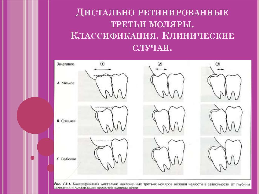 Мудрости на нижней челюсти. Ретинированный зуб классификация. Классификация дистопии и ретенции зубов. Дистопия зуба классификация. Ретенция зуба классификация.