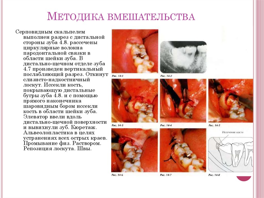 Удаление третьих моляров верхней и нижней челюсти. Ретенция и дистопия ...