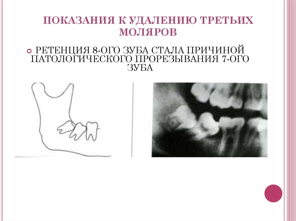 Болезни прорезывания зубов затрудненное прорезывание третьего нижнего моляра презентация