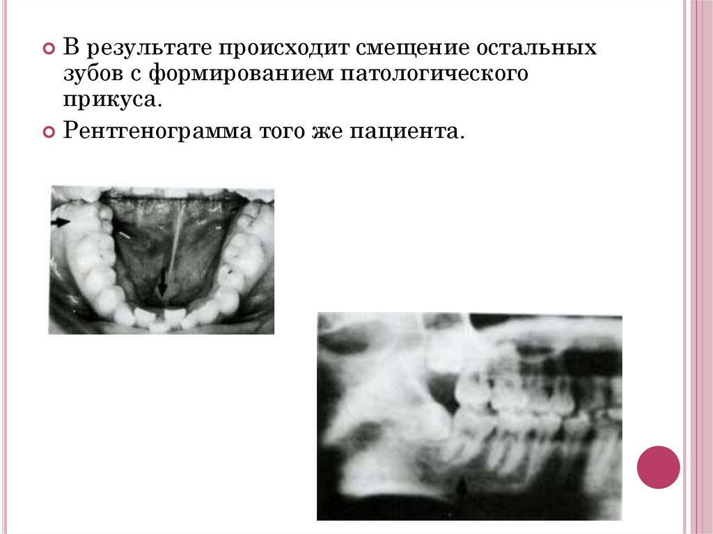 Удаление третьих моляров верхней и нижней челюсти. Ретенция и дистопия ...
