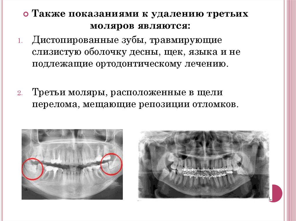 Осложнения при удалении зубов презентация