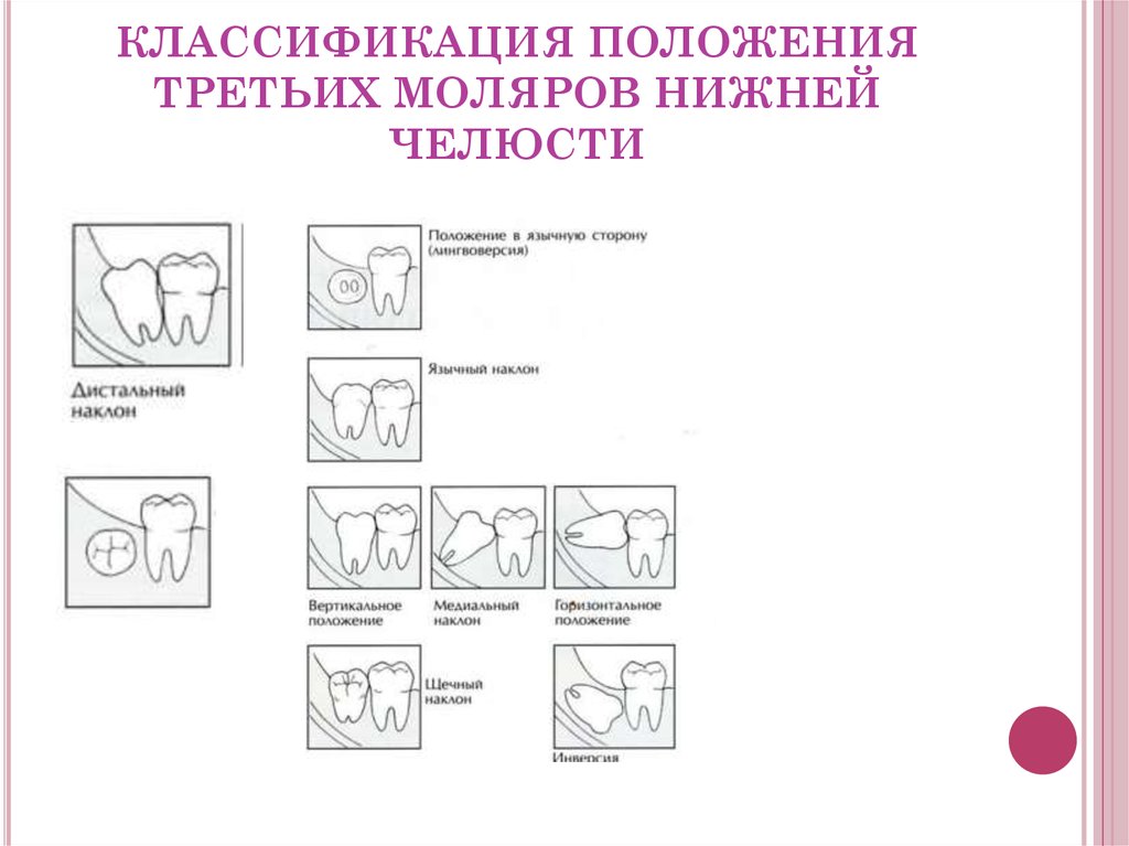 Положение от 03.08 1972. Ретенция третьих моляров. Классификация положения третьих моляров. Классификация положения третьих моляров нижней челюсти. Ретенция классификация.