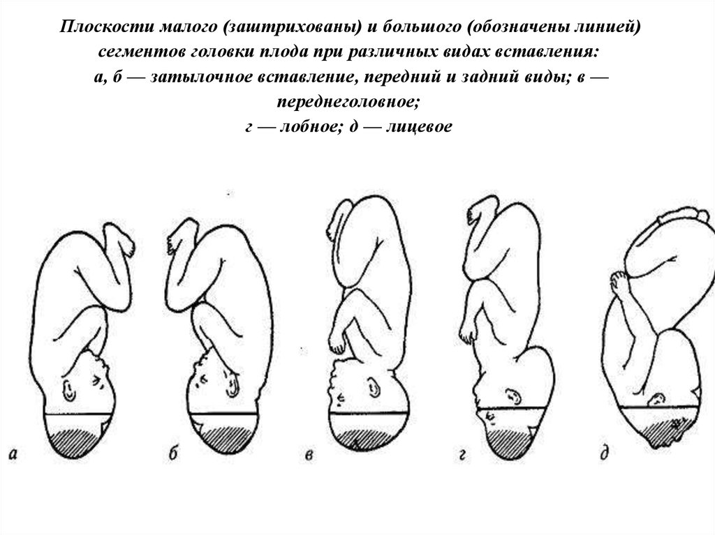 Вставление головки виды