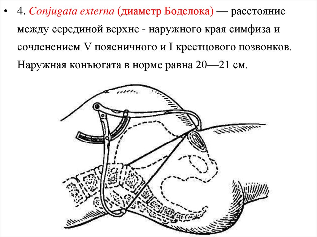 Истинной конъюгатой. Наружная конъюгата в норме равна. Наружная конъюгата в акушерстве. Наружная конъюгата измерение. Измерение наружной конъюгаты таза.