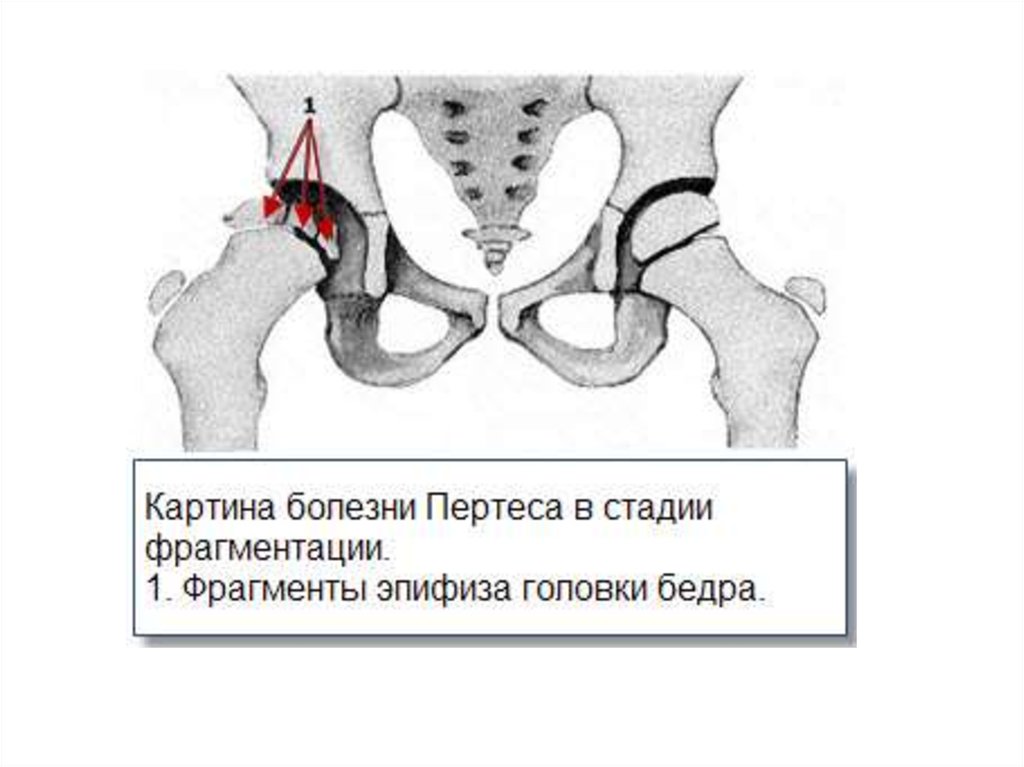 Болезнь пертеса презентация