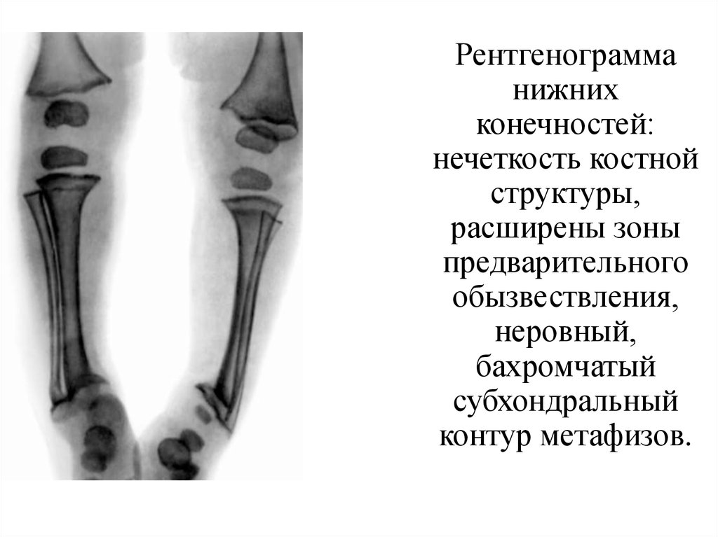 Презентация болезнь пертеса