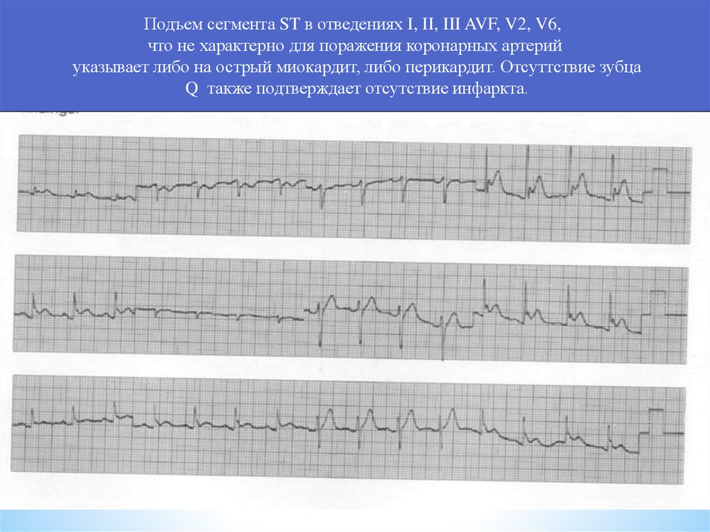 Подъем st в avf. Подъем сегмента St 2 3 AVF. Элевация сегмента St II, III, AVF.. Элевация сегмента St в отведениях II, III, AVF. Подъем сегмента St в отведениях.
